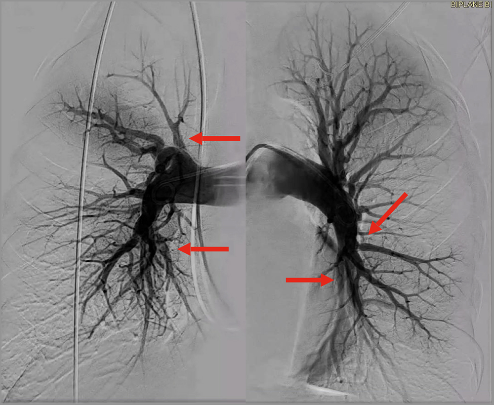 pulmonary angiogram